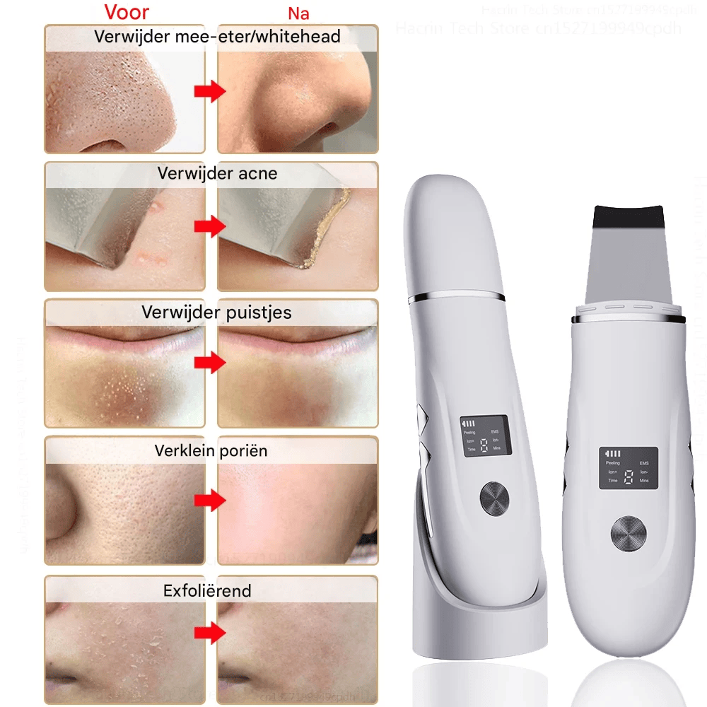 GlowDeep™ 4-in-1 Ultrasone Huidreiniger – Diepe Porie Reiniging, Lifting & Verjonging